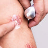 Applying HYALO4 Skin cream to a minor abrasion on hand
